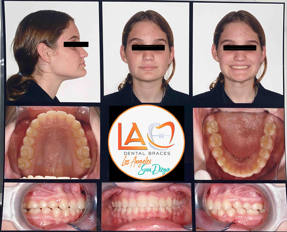 Before and After Photos LA Dental Braces